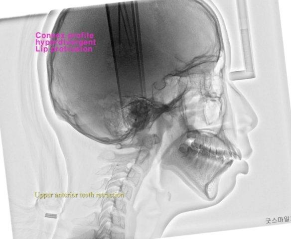 Upper 1st premolars ext. case
she had ICR related…