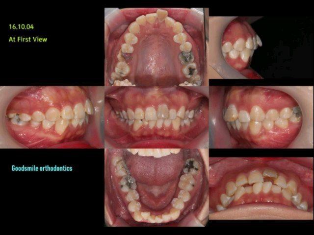 Case report of skeletal class II, dental class II …