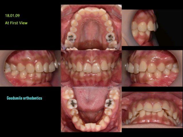 Case report of Class II division 2 patient with de…