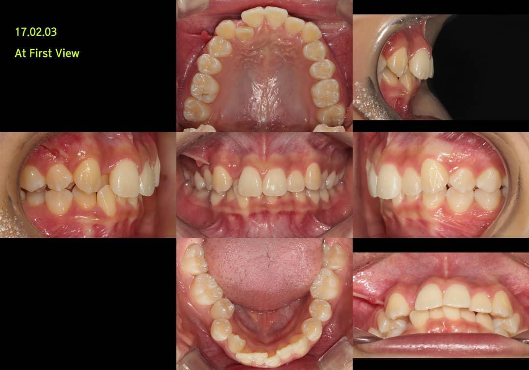 Non-ext treatment of class II Div 2 by using MIs
…