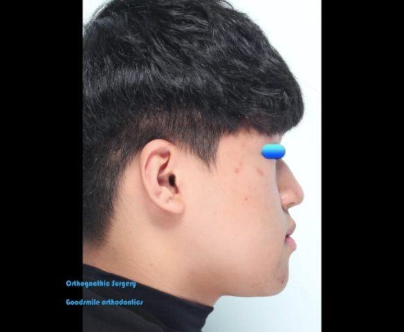 Change of profile after orthognathic surgery combi…