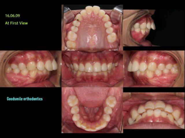 treatment of dental class II division 1 with lip p…