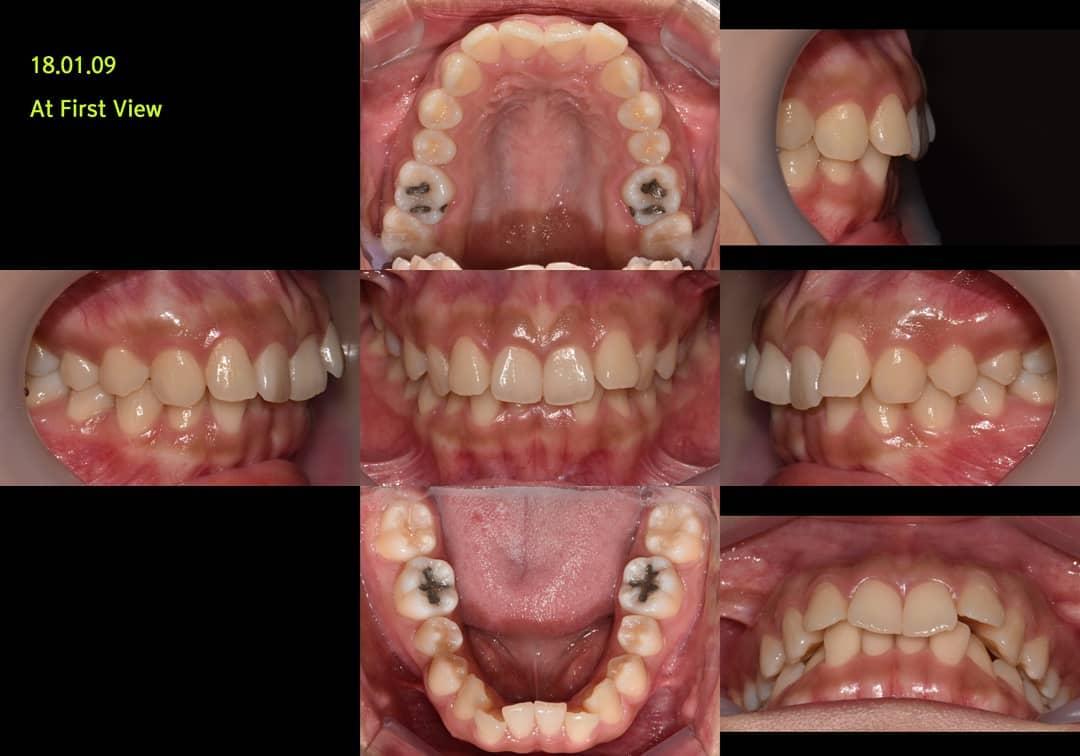 Case report of Class II division 2 patient with d…