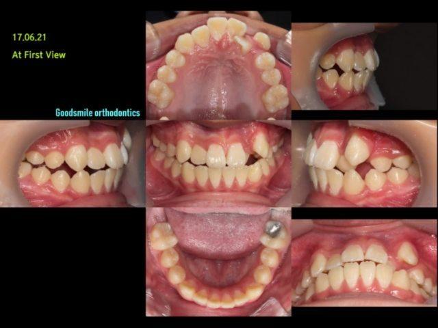 Canine lateralization treatment case of skeletal c…