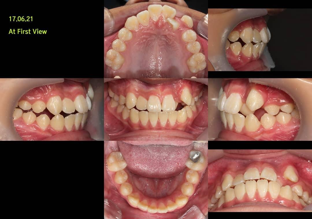 Canine lateralization treatment case of skeletal c…