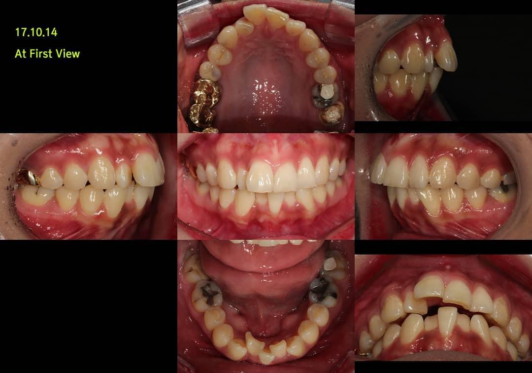Camouflage treatment of skeletal class II, dental …