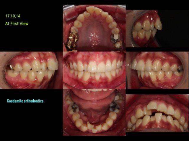 Camouflage treatment of skeletal class II, dental …