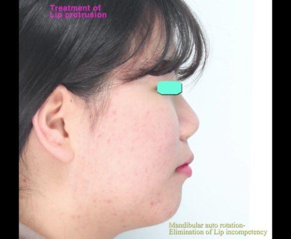 treatment of skeletal class II, dental class II wi…