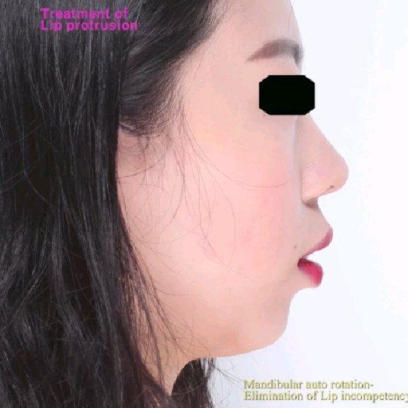 Camouflage treatment of skeletal class II with ICR…