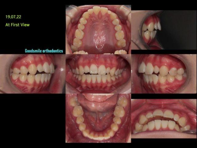 Camouflage treatment of skeletal class II, Dental …
