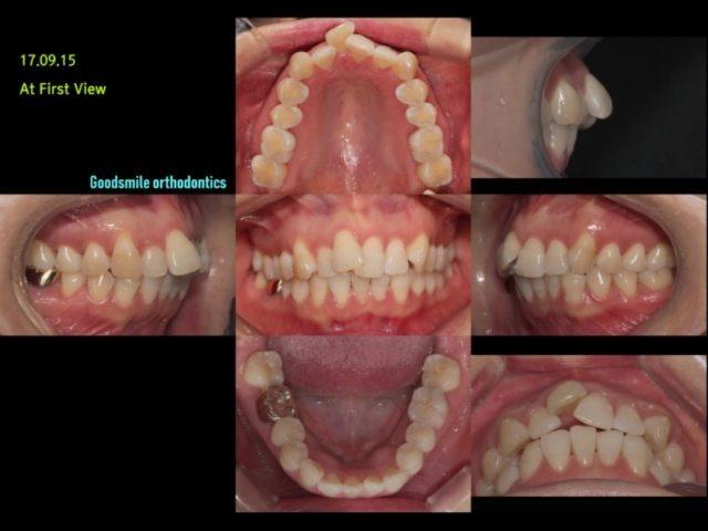 Camouflage treatment of skeletal class II, dental …