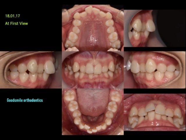 camouflage treatment of skeletal class II, dental …