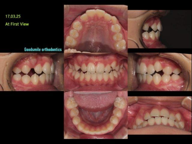 Treatment of skeletal class I with upper ant sever…