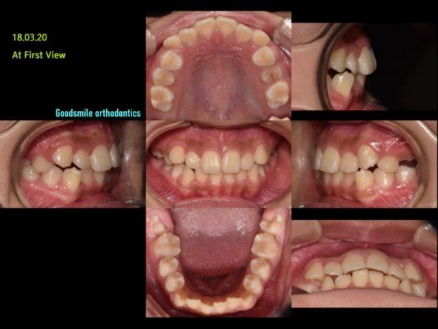 Non-ext treatment of dental class I with both ant …