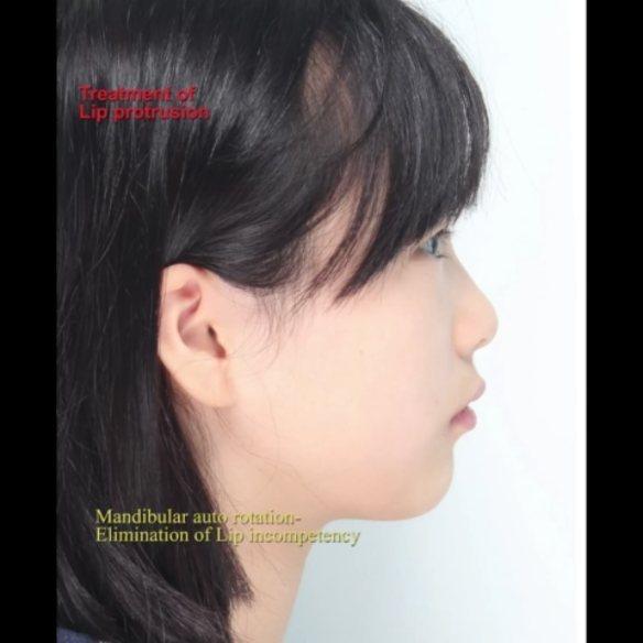 Camouflage treatment of skeletal class II, dental …