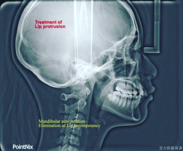 camouflage treatment of skeletal class II, dental …