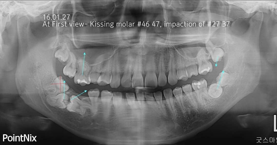 Mid treatment reassessment of kissing molars and 2…