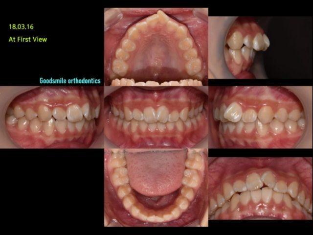 Non-ext treatment of skeletal class I, dental cla…