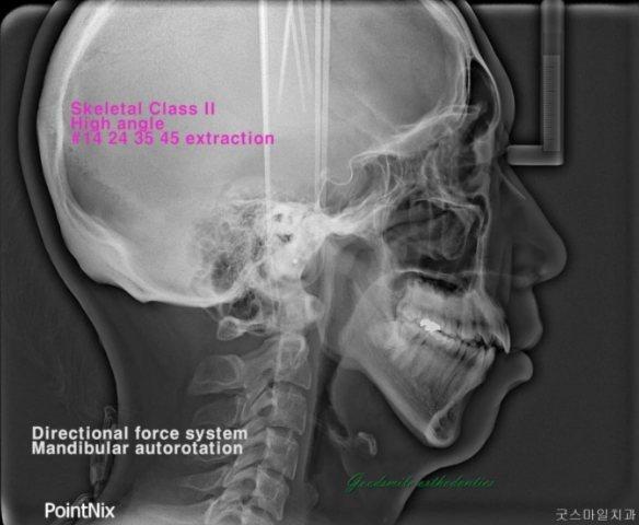 Camouflage treatment of skeletal class II with man…