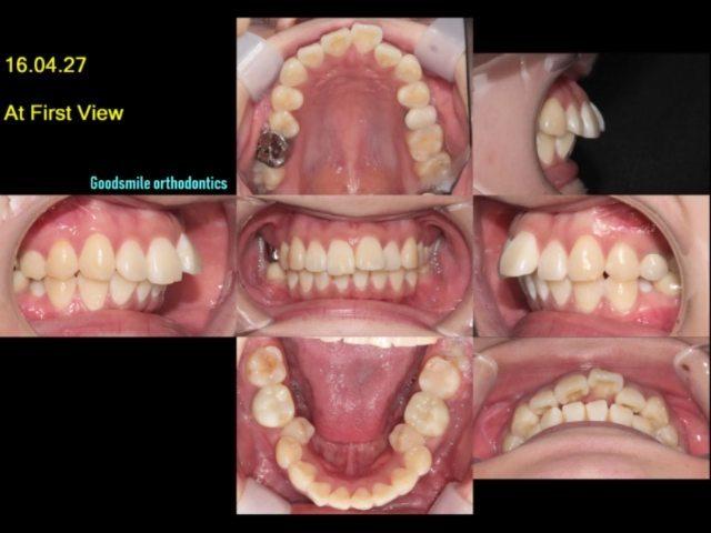 camouflage treatment of skeletal class II with lip…