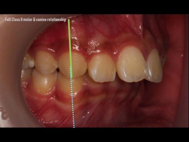 Non-ext treatment of full class II molar and canin…