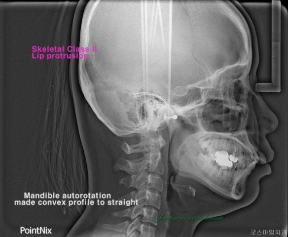Extraction treatment of skeletal class II with lip…