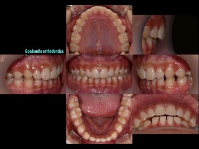 Camouflage treatment of skeletal class II, dental …