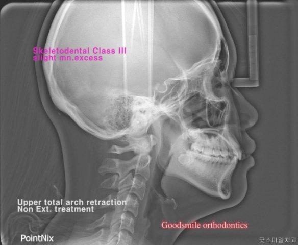upper total arch retraction in some patients, I h…