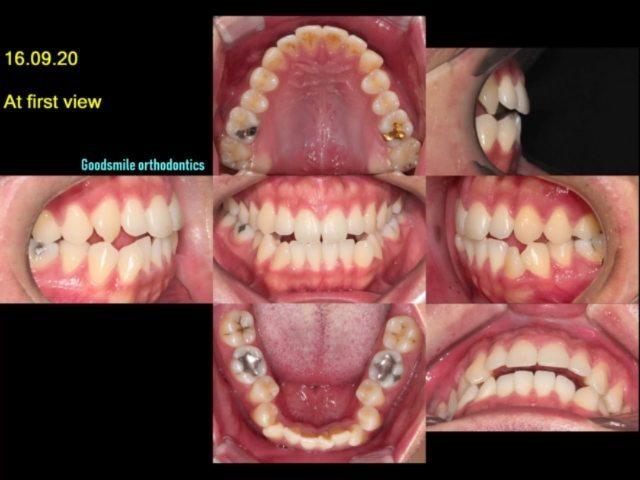Camouflage treatment of skeletal class II with man…