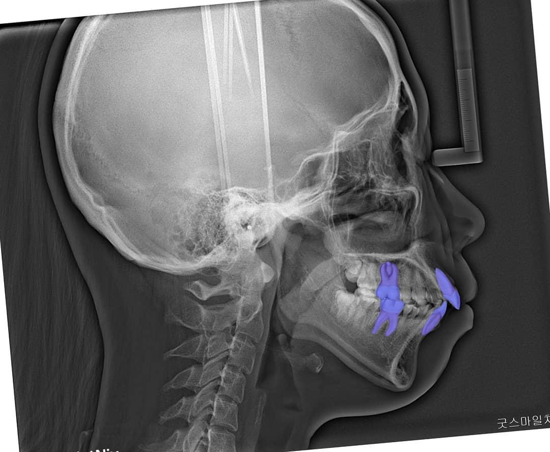case of next month’s arcticleSevere lip protrusi…