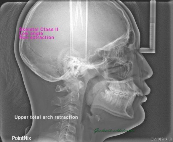 Non-ext treatment of skeletal class II dental clas…