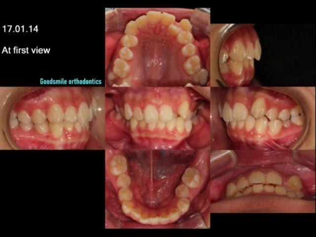 a treatment case of severe crowding skeletal clas…