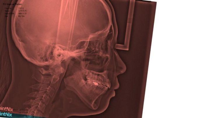 total arch intrusive retraction for treatment of l…