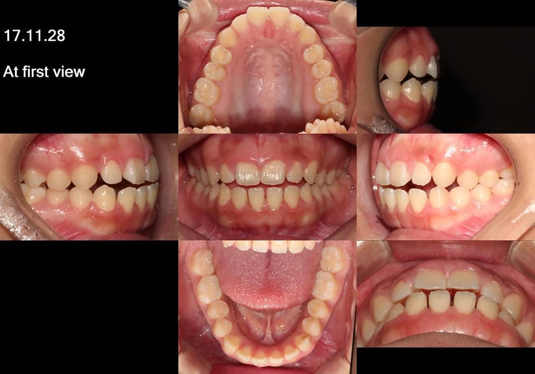 How do you like it?She had vertical maxillary ex…