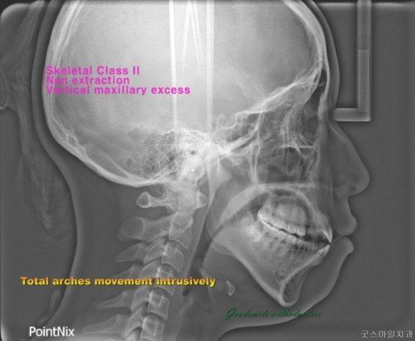 camouflage treatment of Vertical maxillary excess …