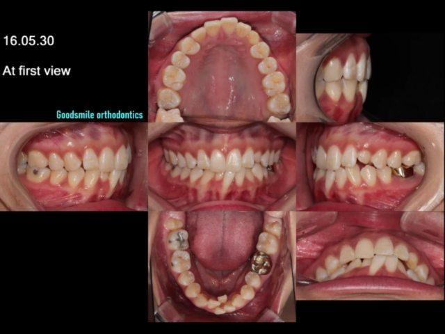 Camouflage treatment of skeletal class II with upp…