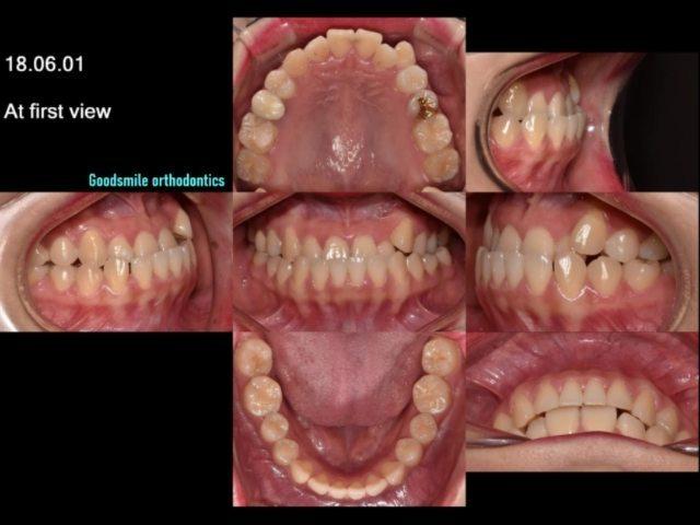 Camouflage treatment of skeletal class III with an…