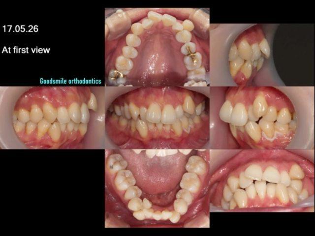 Camouflage treatment of skeletal class II dental c…