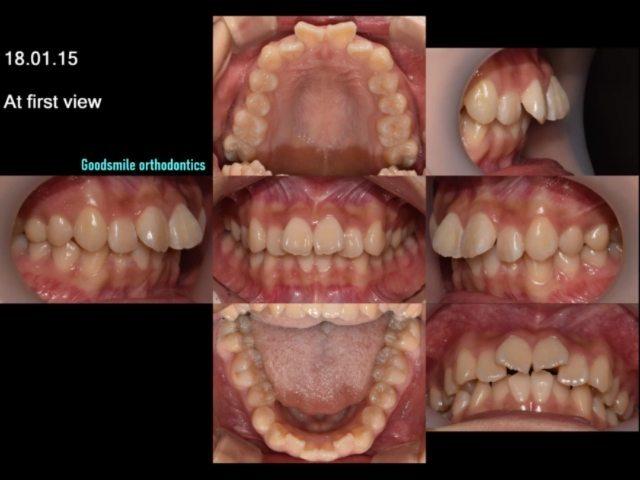 Camouflage treatment of skeletal class II with upp1…