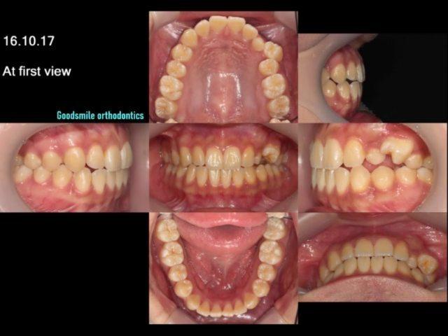 Orthodontic traction for #23 horizontally impacted…