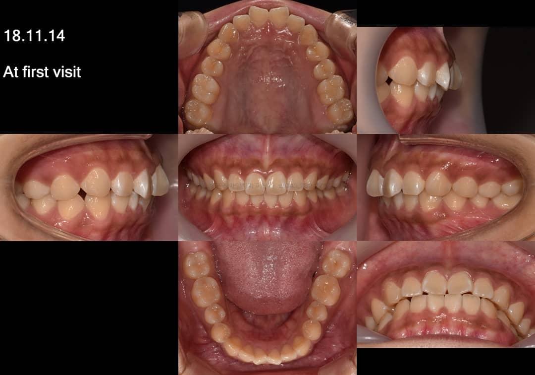 non-ext treatment of dental class I with moderate …