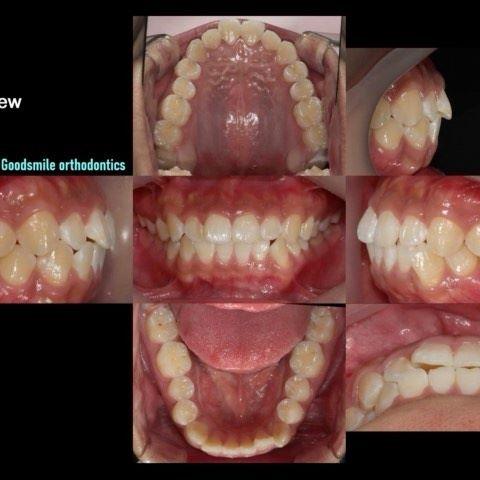 camouflage treatment of skeletal class III with li…
