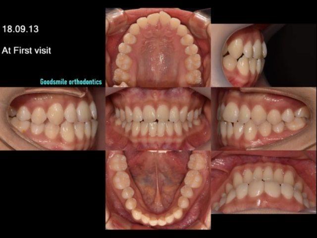 blackshaq Camouflage treatment of skeletal class I…