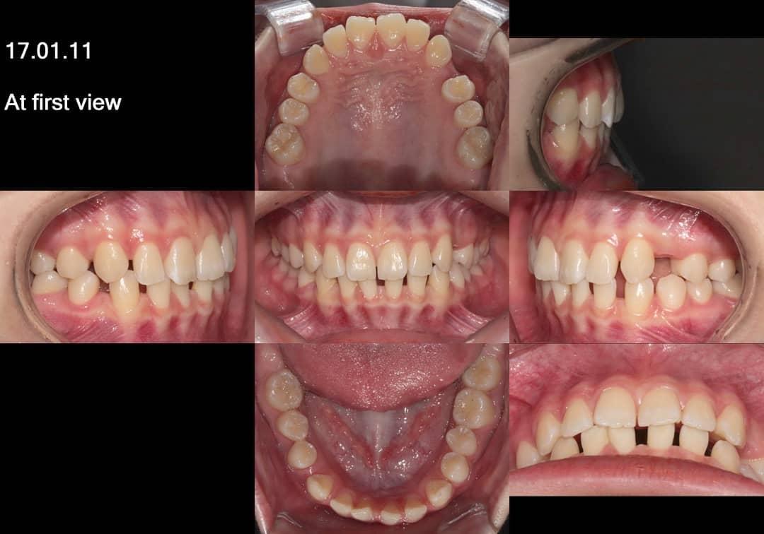 camouflage treatment of skeletal class III with sm…