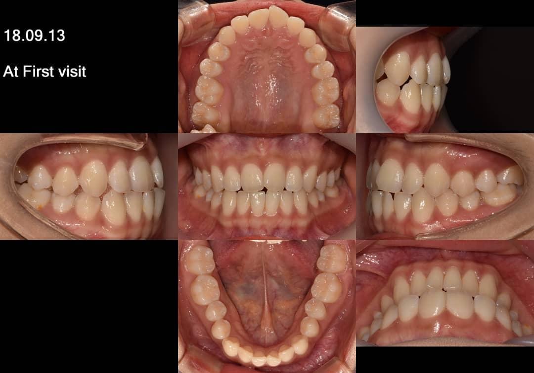 Camouflage treatment of skeletal class III with sm…