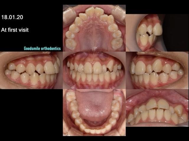Camouflage treatment of skeletal class III with se…