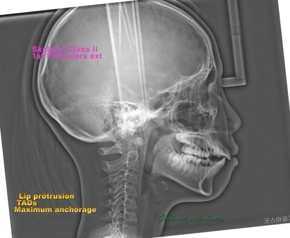 Camouflage treatment of skeletal class II with lip…