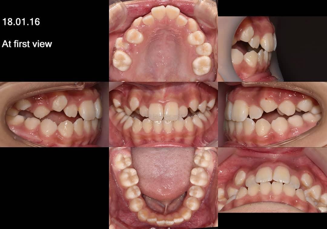 Camouflage treatment of skeletal class III with mo…