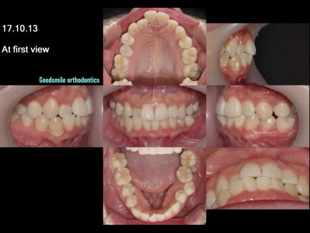 a substitution treatment of lower posterior impact…