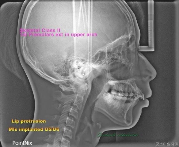Camouflage treatment of skeletal class II with man…